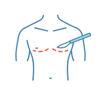 Male Gynaecomastia