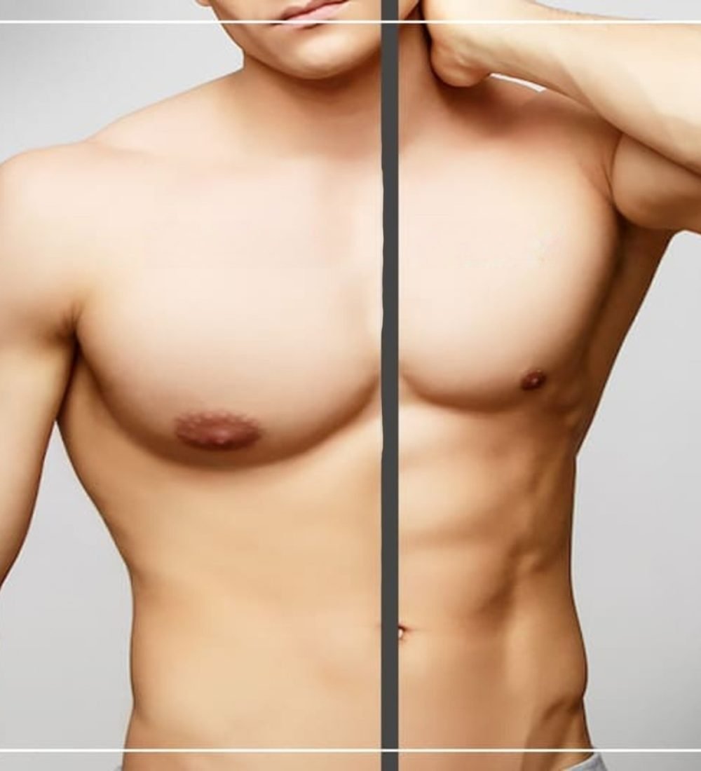 gynecomastia-surgery-before-afte-transformed